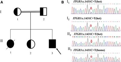 Novel homozygous silent mutation of ITGB3 gene caused Glanzmann thrombasthenia